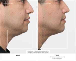 Therabody TheraFace Pro Kasvohierontalaite