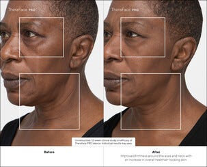 Therabody TheraFace Pro ansiktsmassasje