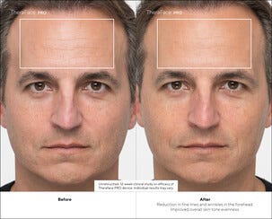 Therabody TheraFace Pro ansiktsmassasje