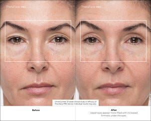 Therabody TheraFace Pro Kasvohierontalaite